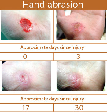 hand-abrasion